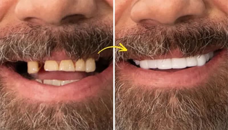 Custom Shiny Smile veneers kit photographed on a bathroom counter