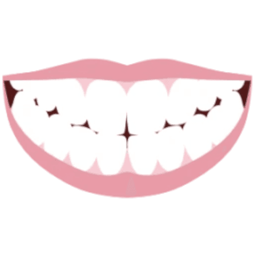 Instasmile snap-on veneers