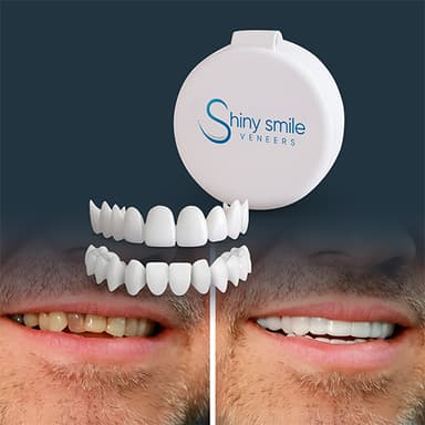 Shiny Smile snap-on veneers kit with before and after smile