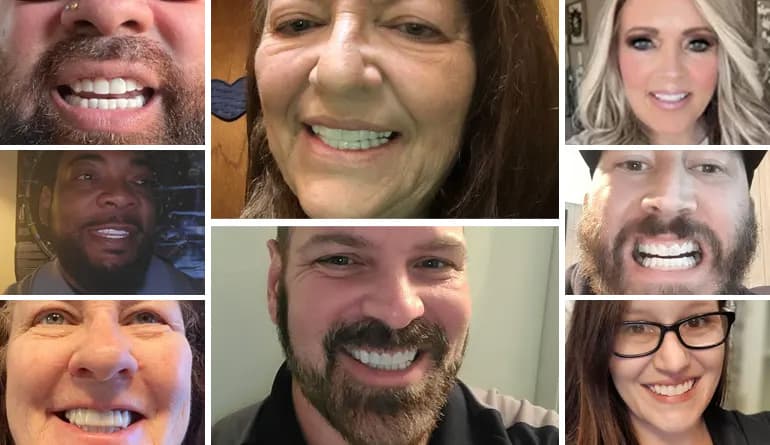 Shiny Smile customer showing veneers starter kit